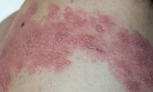 Cách nào ngăn đau thần kinh sau zona kéo dài?